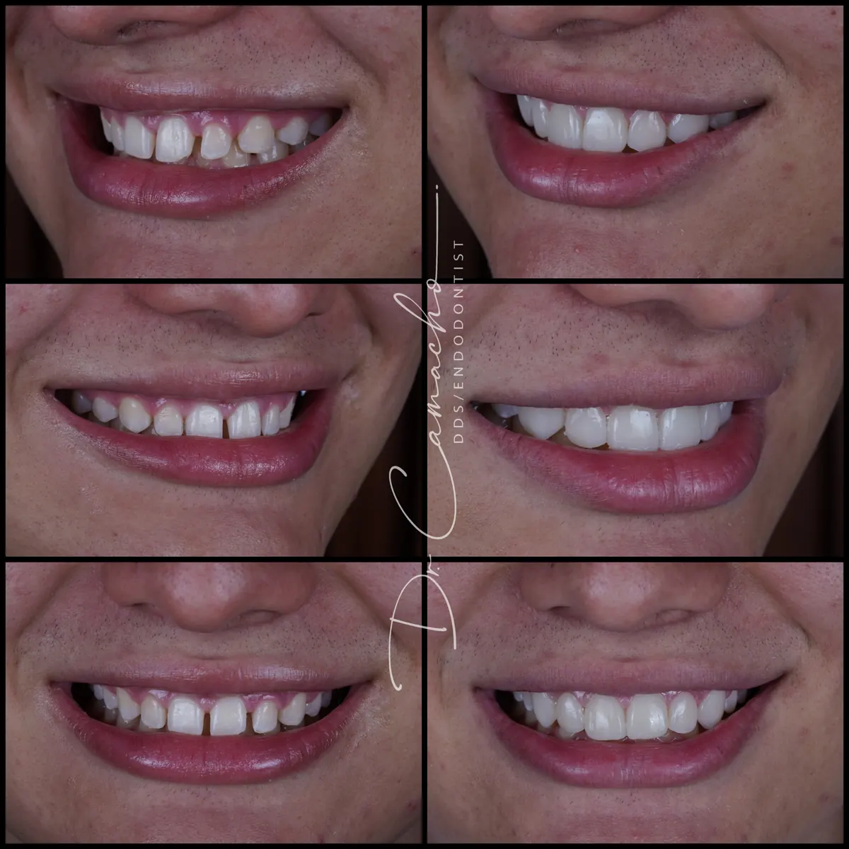 Antes y después de tratamiento dental — caso 1