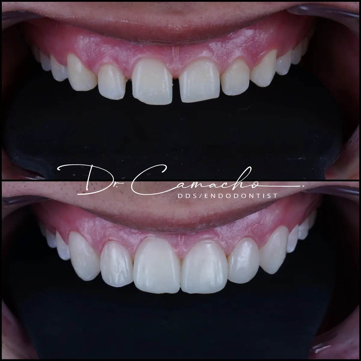 Resultado estético dental Dr. Camacho