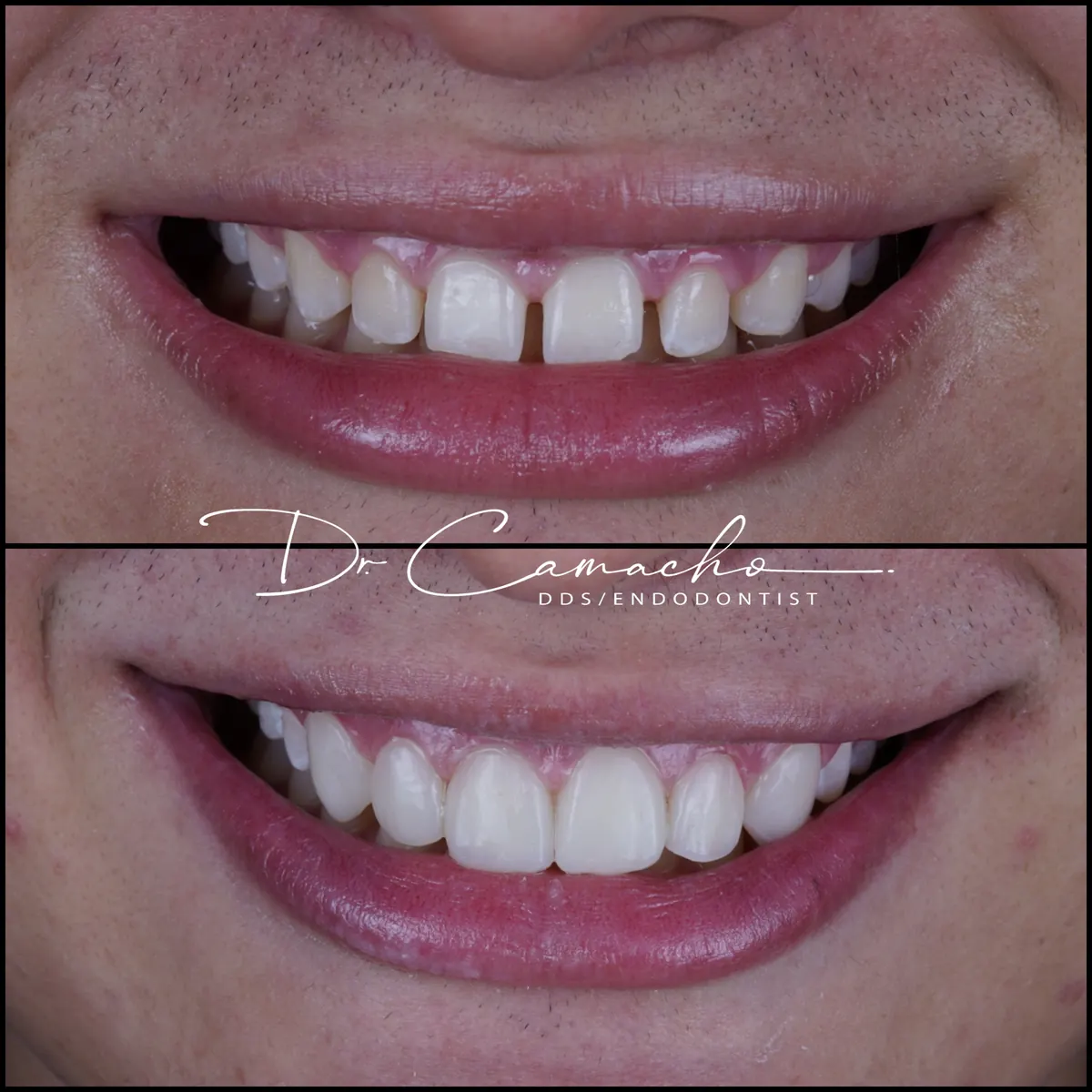 Antes y después de tratamiento dental — caso 3