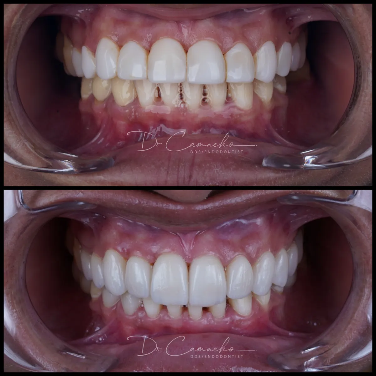 Antes y después de tratamiento dental — caso 4