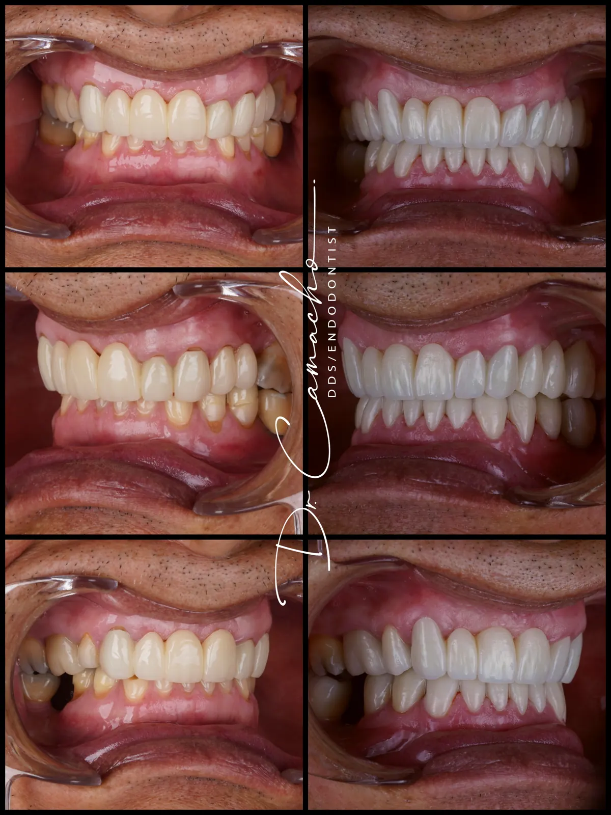 Antes y después de tratamiento dental — caso 5