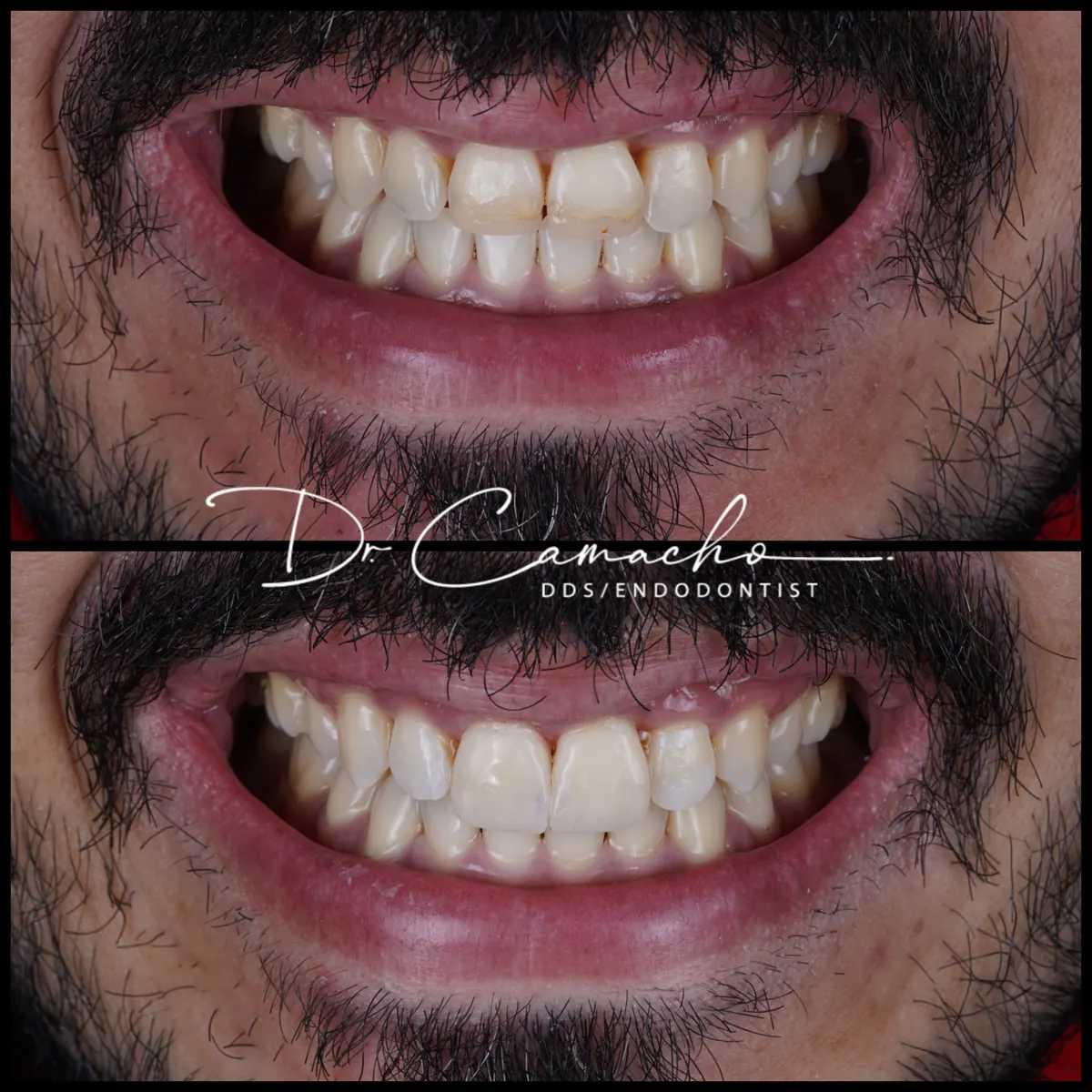 Antes y después de tratamiento dental — caso 6