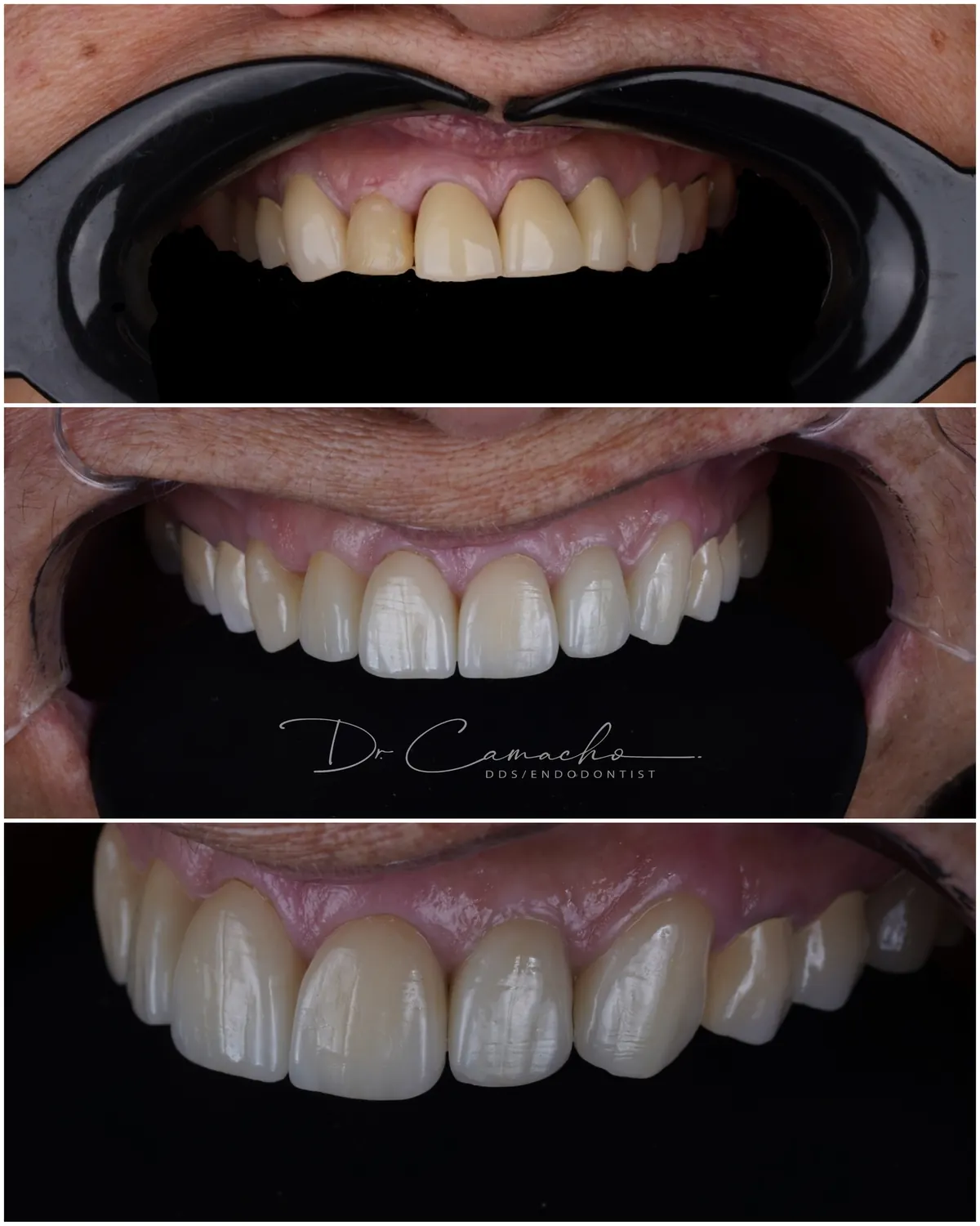 Antes y después de tratamiento dental — caso 7