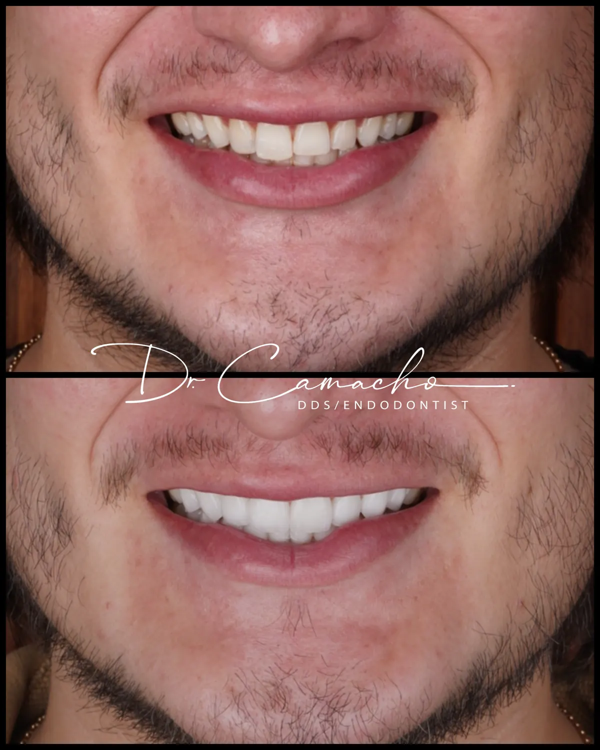 Antes y después de tratamiento dental — caso 8